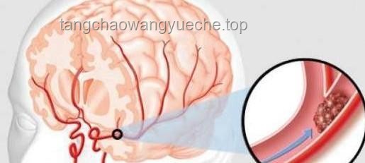 女生突發(fā)腦出血后竟“失去”說英語(yǔ)能力：癥狀解析與應(yīng)對(duì)