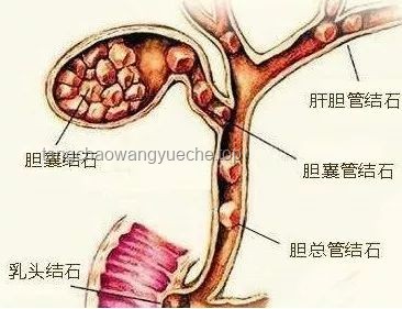 **長(zhǎng)期夜班與膽囊結(jié)石風(fēng)險(xiǎn)：一女子10年夜班生活與95顆結(jié)石的警示**