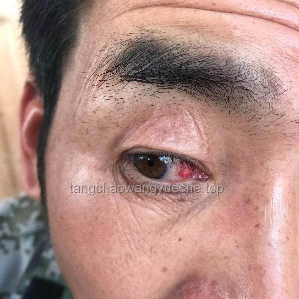**右眼狂飆淚？警惕！這可能是淚囊里長了瘤子的信號**