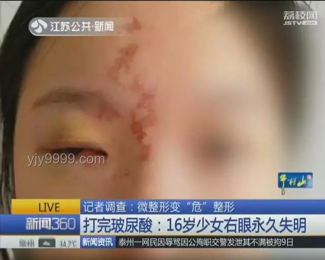 女子右眼狂飆淚：淚囊腫瘤背后的診療故事