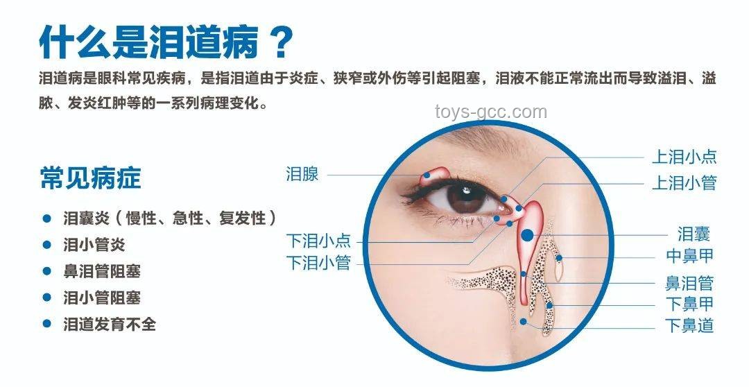 **淚囊異常癥狀對(duì)比：女子右眼狂飆淚與常見(jiàn)淚道疾病**