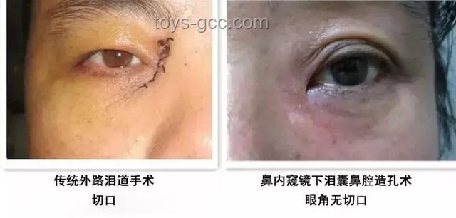 **淚囊異常癥狀對(duì)比：女子右眼狂飆淚與常見(jiàn)淚道疾病**