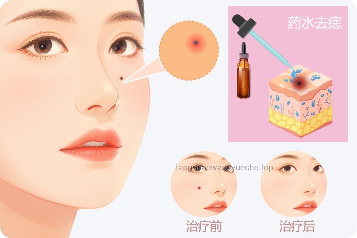 **女子右眼狂飆淚背后的真相：淚囊瘤與非病理流淚的對(duì)比分析**