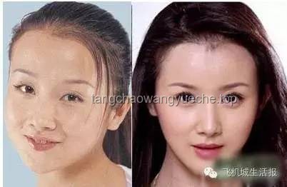 演員孫菲菲整容風(fēng)波背后的真相：庫欣式綜合征知多少？