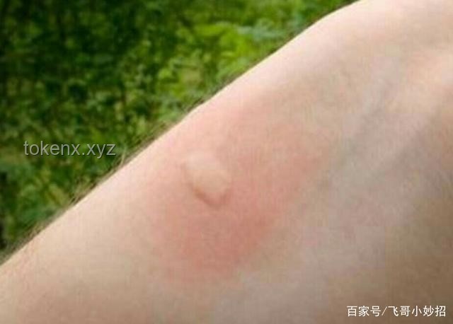 **被蚊子咬了？這4個(gè)迅速止癢的妙招，真心希望你永遠(yuǎn)用不上！**