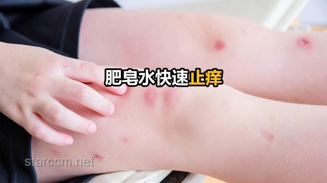 **被蚊子咬了能迅速止癢的4個(gè)方法，希望大家都用不上！**