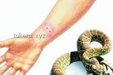 被蛇咬后應急處理方案