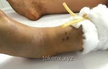 被蛇咬后應急處理方案