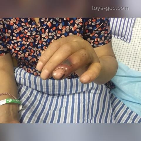 男子被蝮蛇咬傷凸顯血清短缺問題