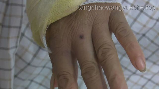 男子被蝮蛇咬傷全市尋適配血清案研究