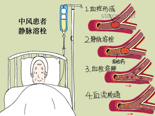 網(wǎng)紅健康風(fēng)險上升，急性腦梗年輕化趨勢預(yù)警