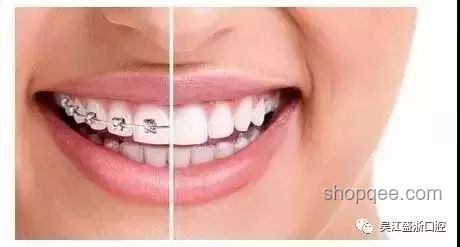 Labubu牙套變形記：從尷尬到自信的轉(zhuǎn)變