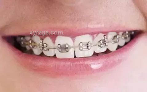 Labubu牙套與傳統(tǒng)牙套對比分析