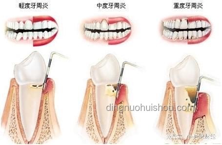 韋神牙周炎治療全攻略，輕松守護(hù)口腔健康