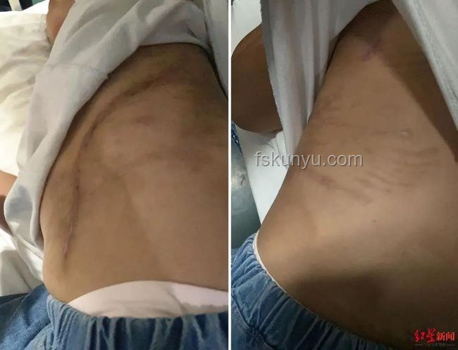 女生河邊散步遇蝮蛇咬傷應(yīng)急處理指南