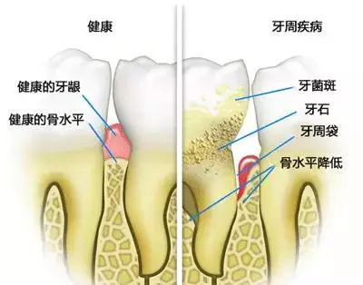 韋東奕牙周炎治療啟示：跨界健康創(chuàng)新之道