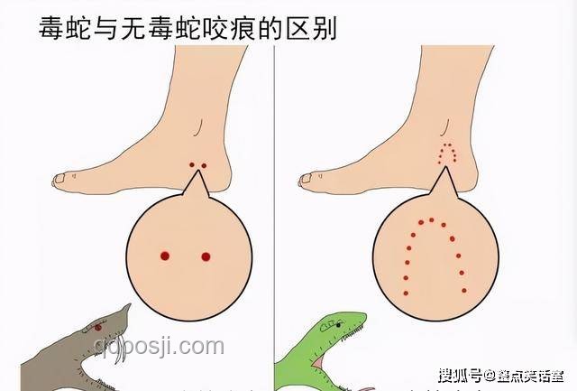 三亞被咬女子案：了解神經(jīng)毒蛇咬傷知識