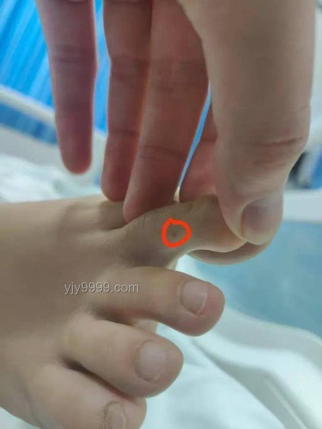 三亞被咬女子神經(jīng)毒蛇咬傷案例研究