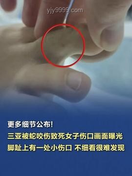 三亞被咬女子神經(jīng)毒蛇咬傷案例研究