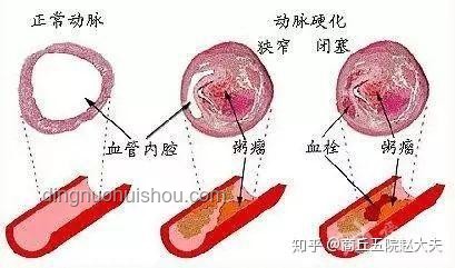硬化血管“石化”術(shù)：醫(yī)療創(chuàng)新的取石奇緣