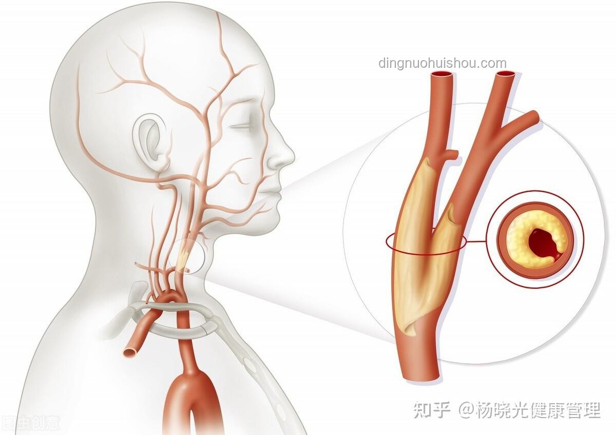 硬化血管“石化”術(shù)：醫(yī)療創(chuàng)新的取石奇緣