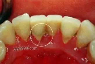 北大“韋神”牙齒問題案例研究：牙周炎的忽視與應(yīng)對
