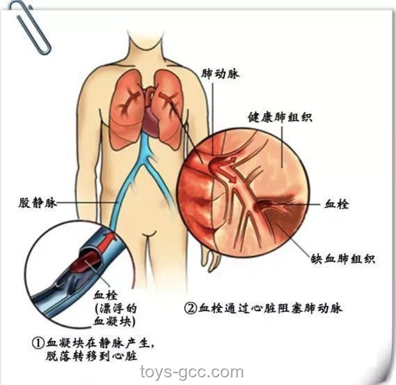 男子運動拉伸險致命：了解肺動脈栓塞