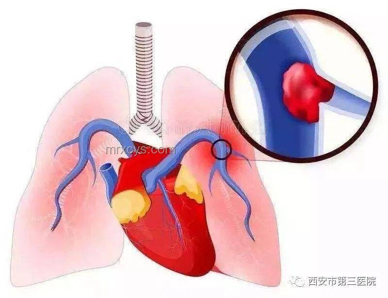 男子運(yùn)動拉伸與肺動脈栓塞風(fēng)險對比分析