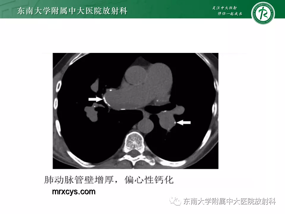 男子運(yùn)動拉伸與肺動脈栓塞風(fēng)險對比分析