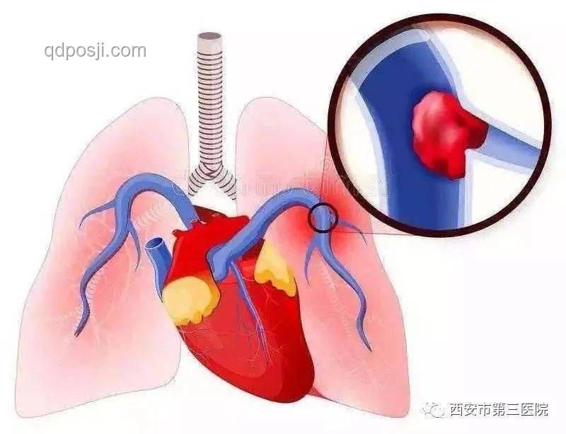 男子不當(dāng)運(yùn)動(dòng)拉伸與肺動(dòng)脈栓塞風(fēng)險(xiǎn)對(duì)比分析
