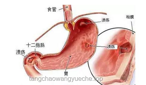 老人胃炎誤切全胃？醫(yī)院回應(yīng)背后的真相與思考