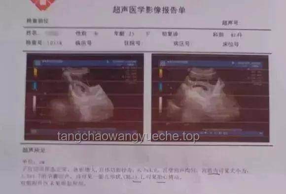 女子腹脹做B超意外誕下男嬰：孕期檢查與應(yīng)對指南