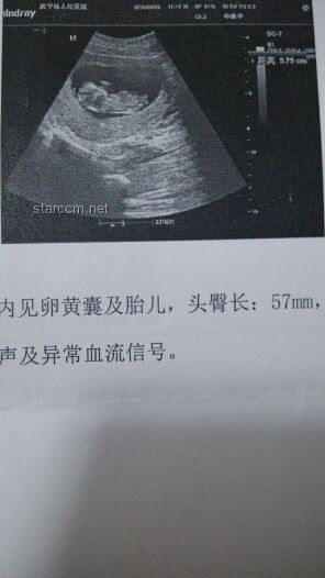 女子腹脹做B超意外誕下男嬰：孕期檢查與應(yīng)對指南