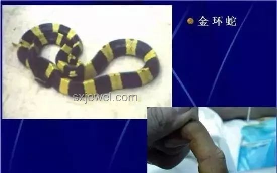 網(wǎng)絡(luò)熱門長蟲案例：男子40天遭毒蛇7咬生還