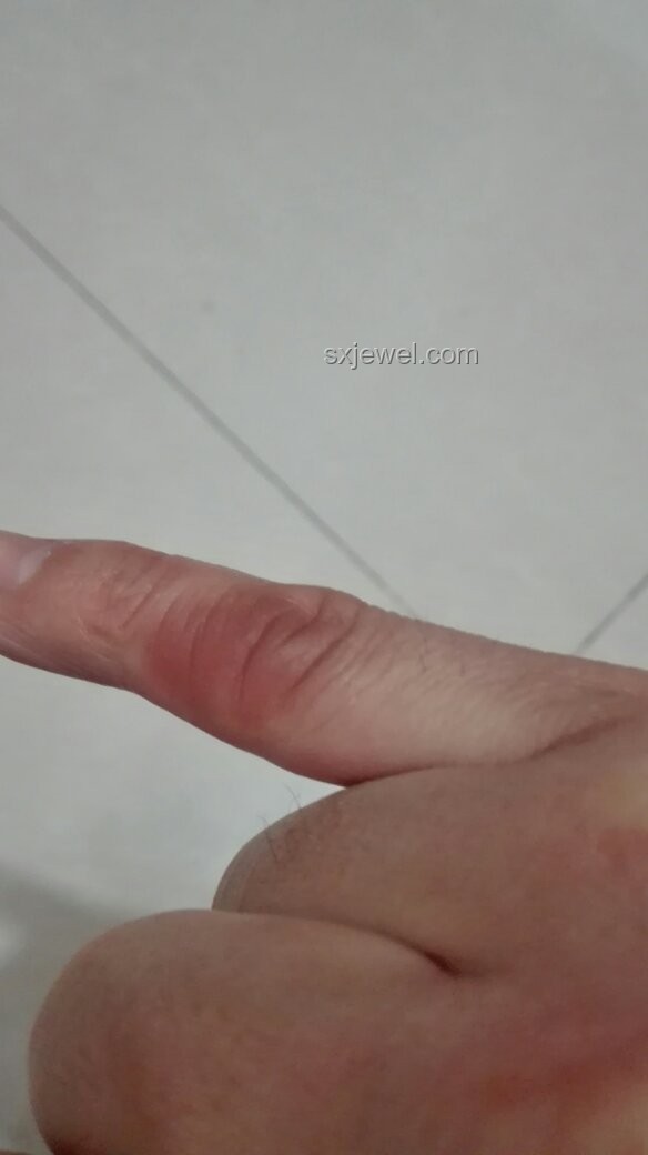 皮膚變厚與腳氣行業(yè)深度洞察