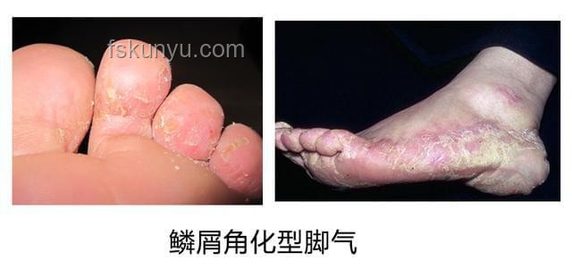 皮膚變厚與腳氣的對(duì)比分析 皮膚變厚與腳氣的對(duì)比分析